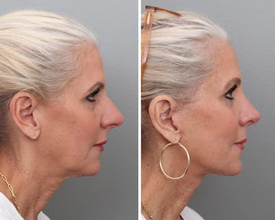 Facelift Before & After Gallery - Patient 232556 - Image 1