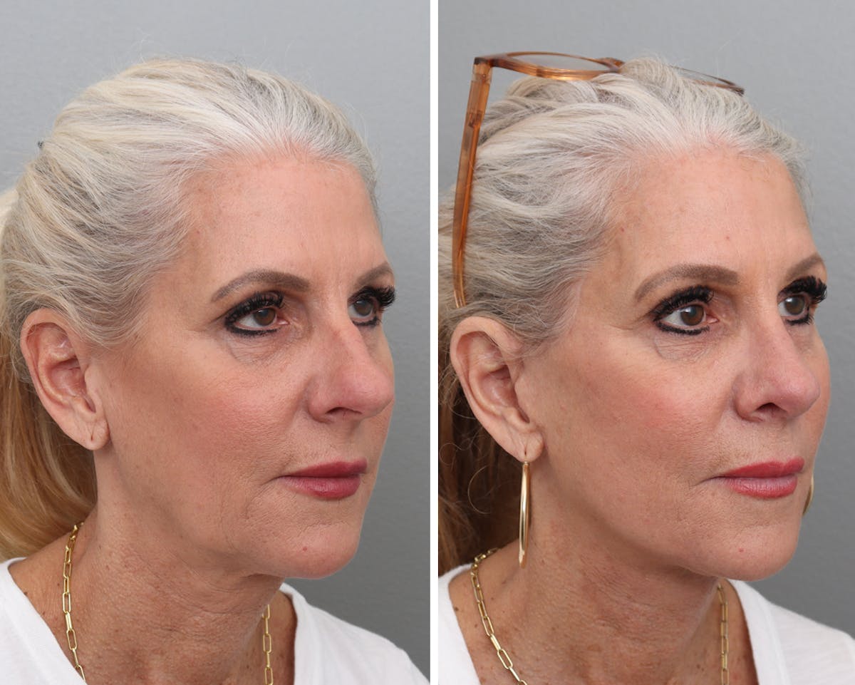 Facelift Before & After Gallery - Patient 232556 - Image 2