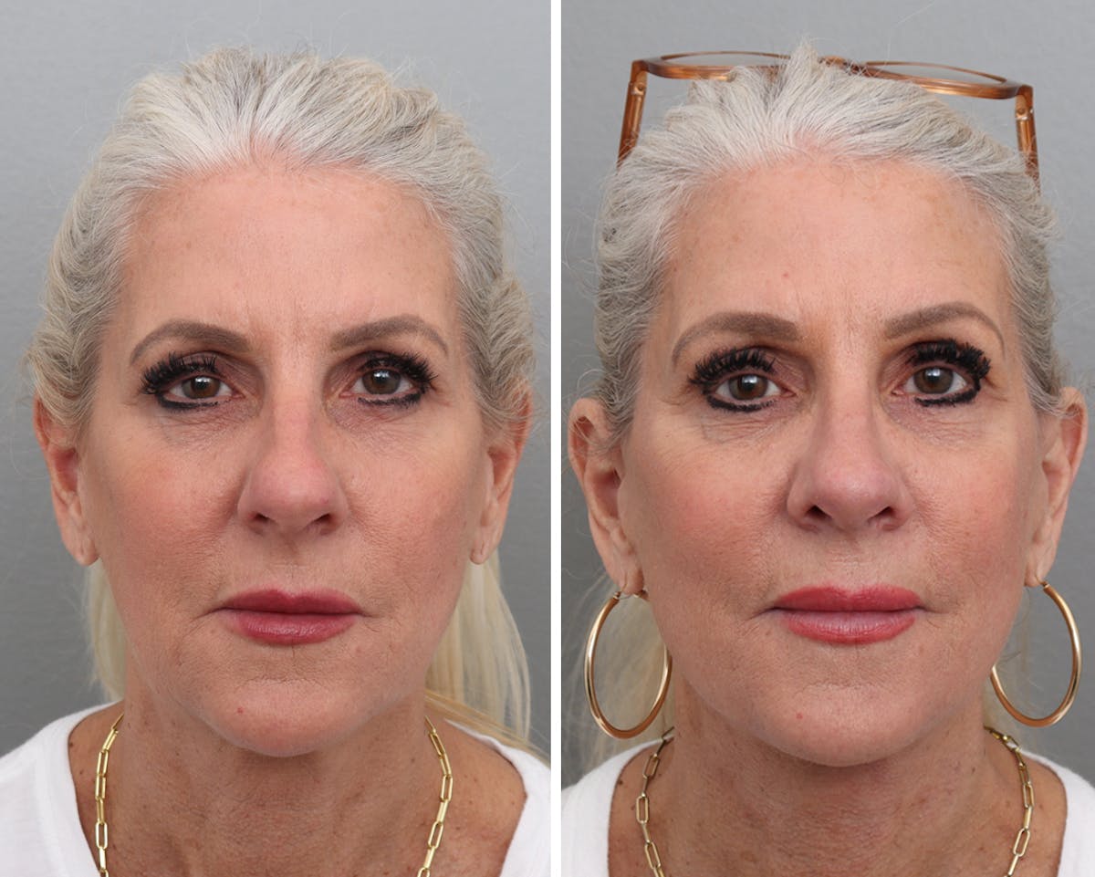 Facelift Before & After Gallery - Patient 232556 - Image 3