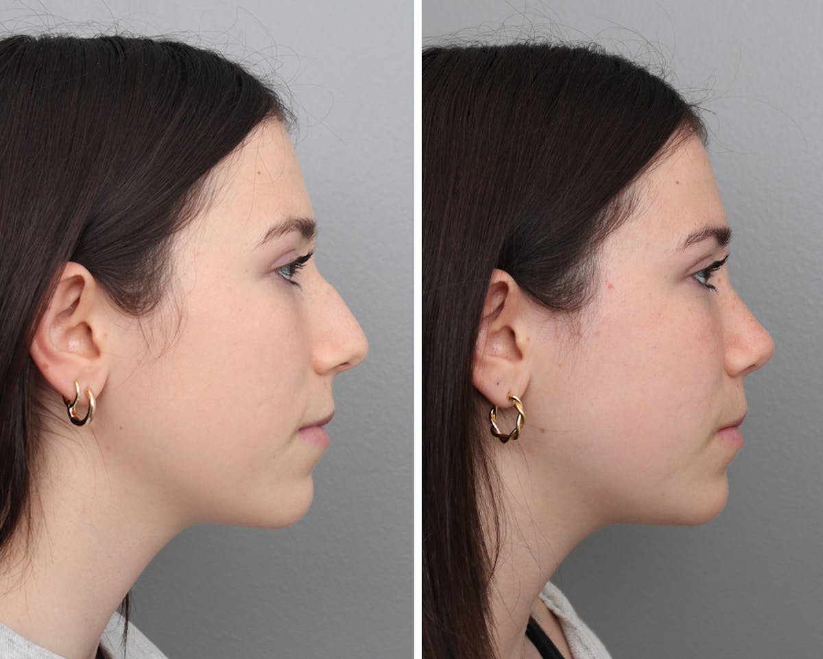 Rhinoplasty Before & After Gallery - Patient 892726 - Image 1