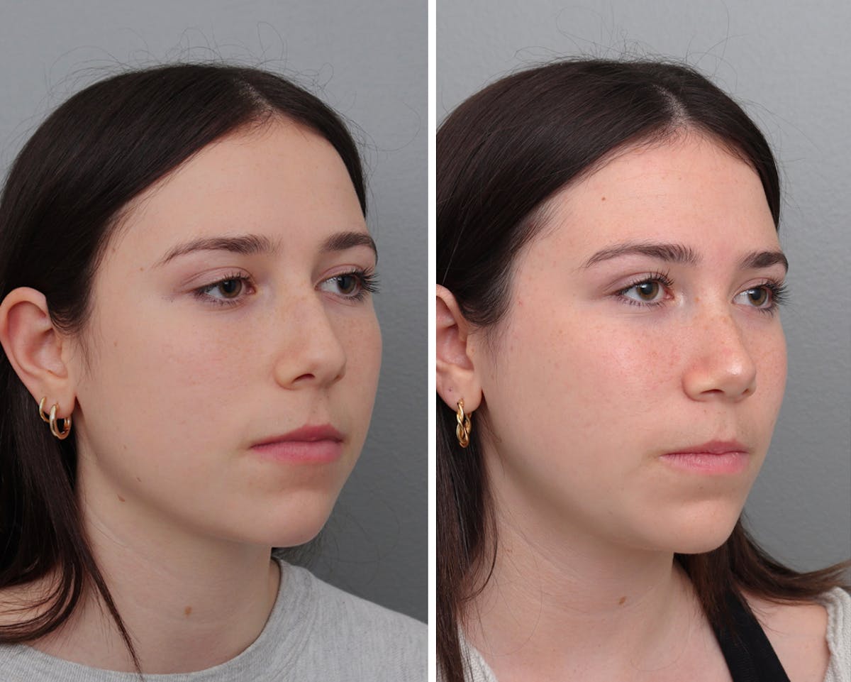 Rhinoplasty Before & After Gallery - Patient 892726 - Image 2