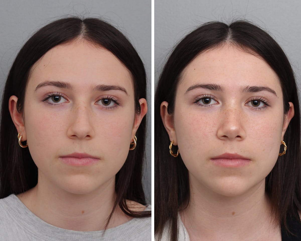 Rhinoplasty Before & After Gallery - Patient 892726 - Image 3