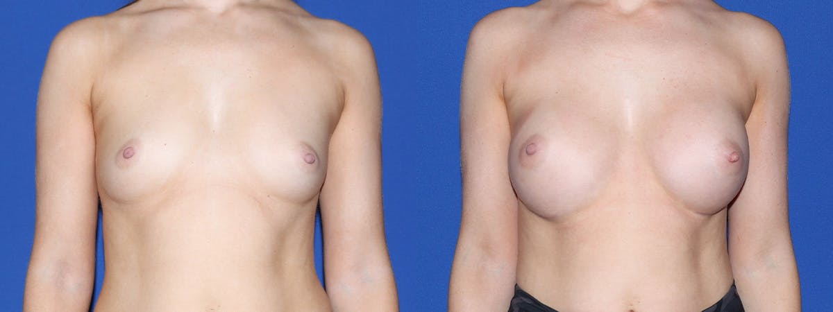 Breast Augmentation Before & After Gallery - Patient 234987 - Image 2