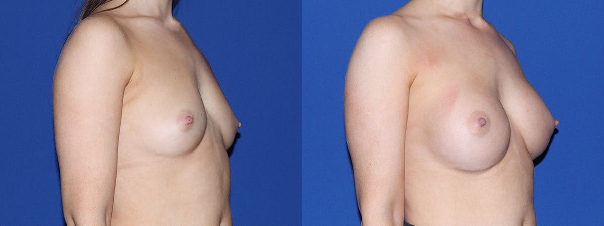 Breast Augmentation Before & After Gallery - Patient 234987 - Image 3