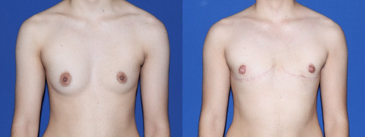 Female to Male Top Surgery Before & After Gallery - Patient 387438 - Image 1
