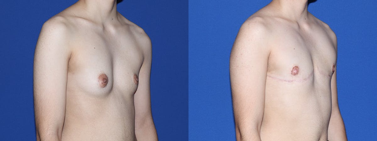 Female to Male Top Surgery Before & After Gallery - Patient 387438 - Image 3