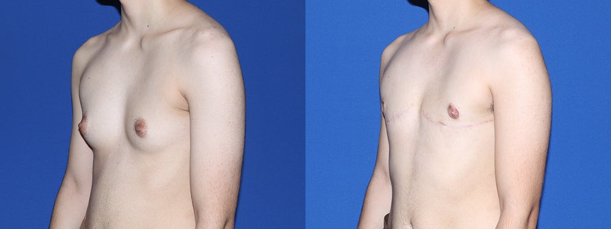 Female to Male Top Surgery Before & After Gallery - Patient 387438 - Image 2