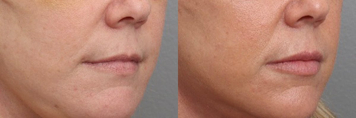Lip Augmentation Before & After Gallery - Patient 337761 - Image 2