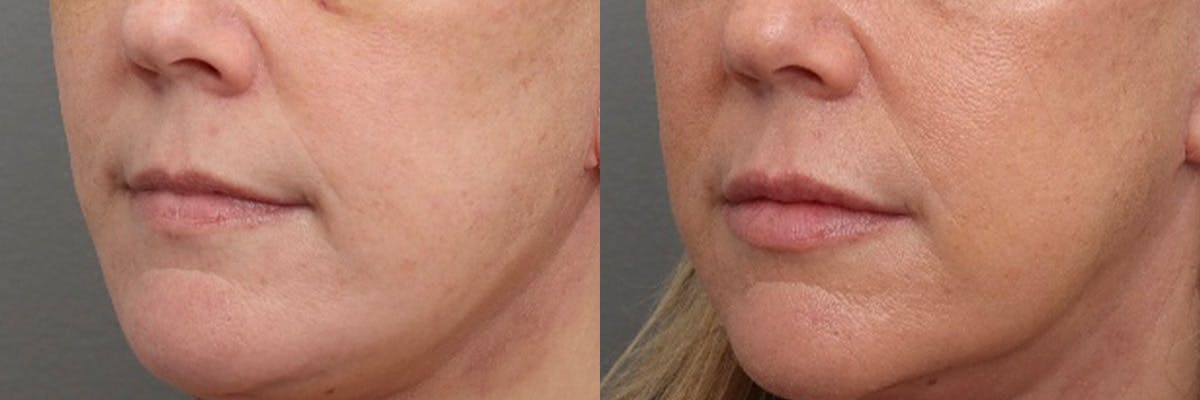 Lip Augmentation Before & After Gallery - Patient 337761 - Image 4