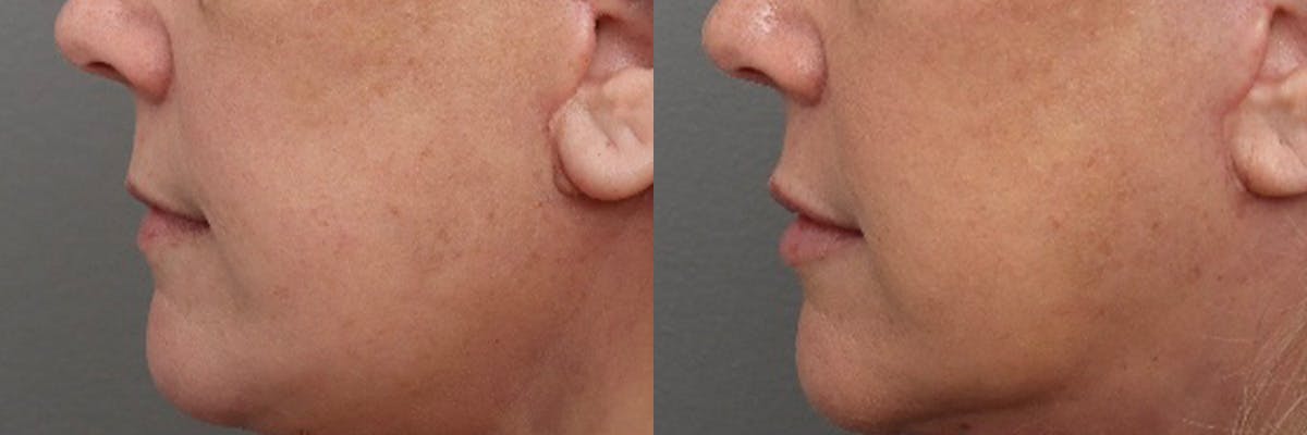 Lip Augmentation Before & After Gallery - Patient 337761 - Image 5