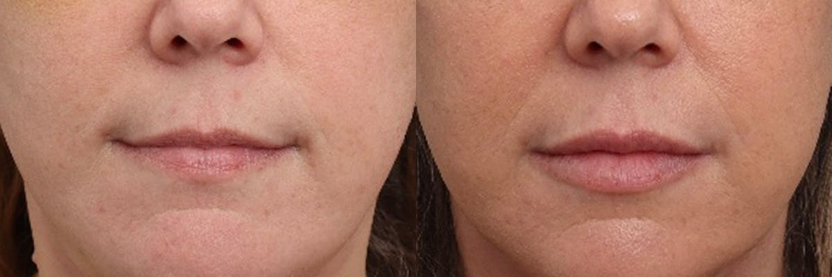 Lip Augmentation Before & After Gallery - Patient 337761 - Image 1