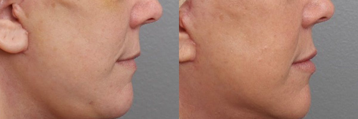 Lip Augmentation Before & After Gallery - Patient 337761 - Image 3