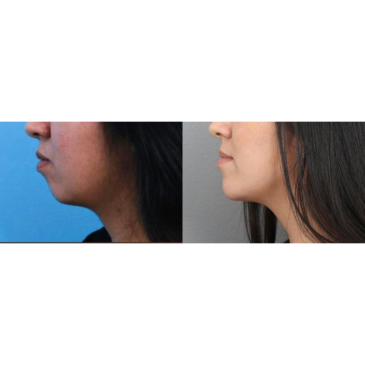 Jawline/Chin Before & After Gallery - Patient 104569094 - Image 1