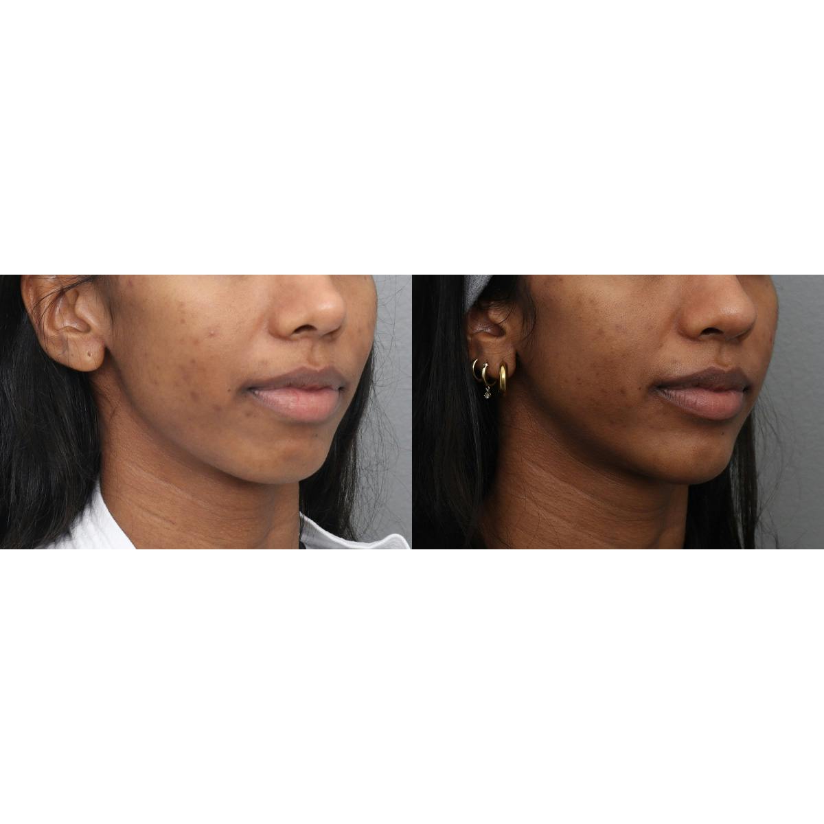 Jawline/Chin Before & After Gallery - Patient 366579 - Image 2