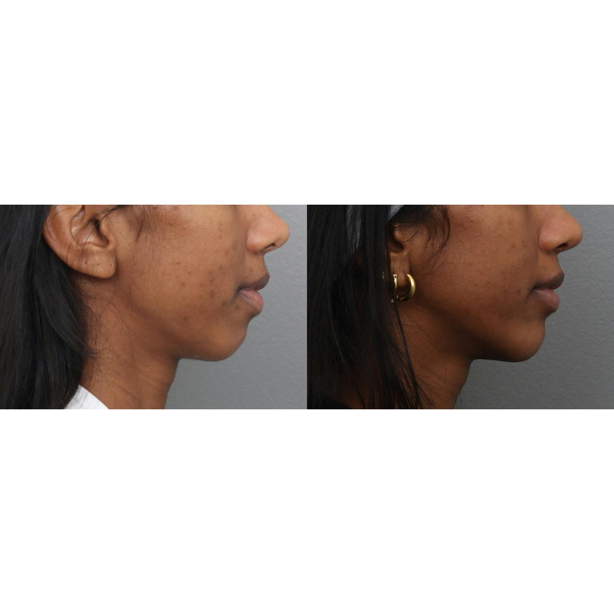 Jawline/Chin Before & After Gallery - Patient 366579 - Image 3