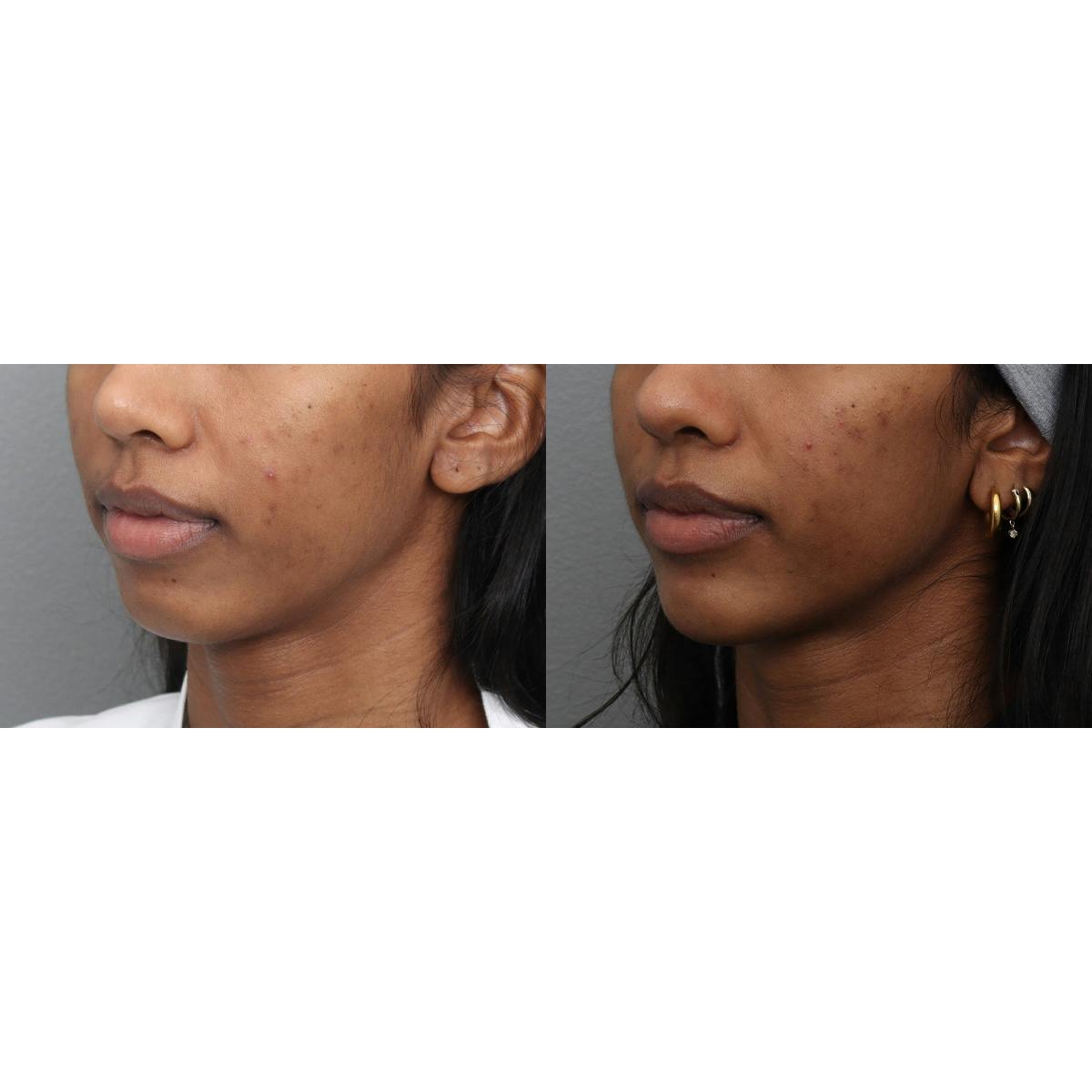 Jawline/Chin Before & After Gallery - Patient 366579 - Image 4