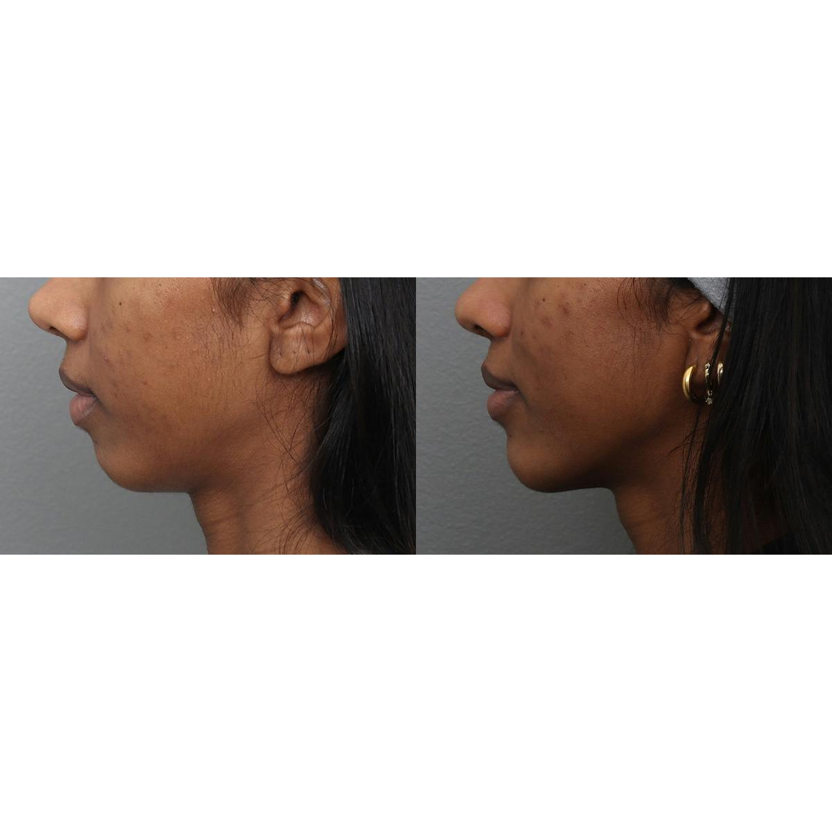 Jawline/Chin Before & After Gallery - Patient 366579 - Image 5