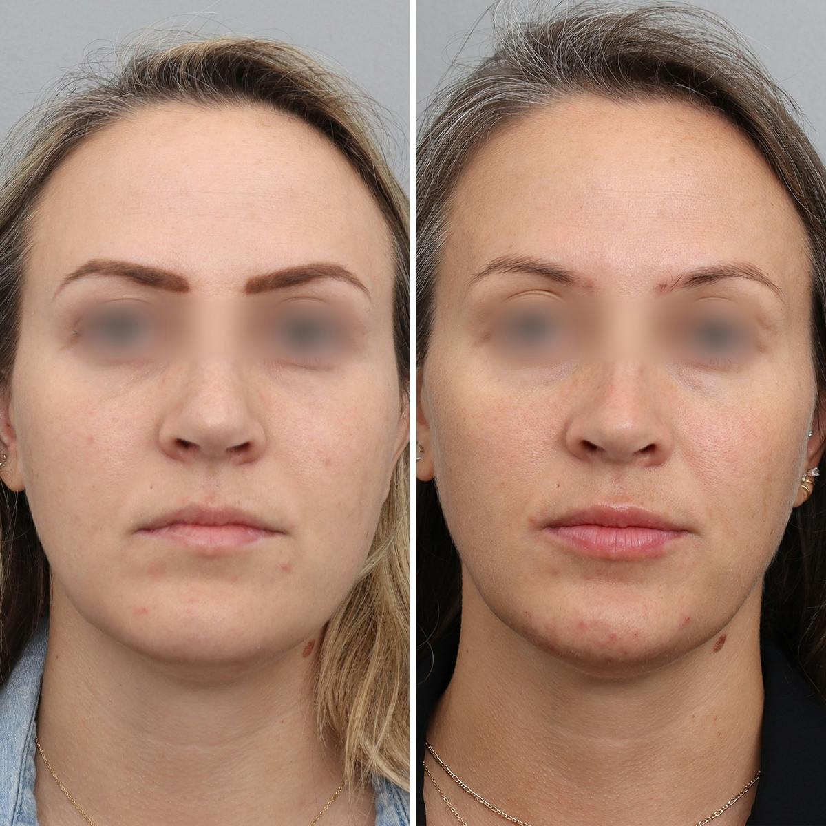 Jawline/Chin Before & After Gallery - Patient 361607 - Image 1