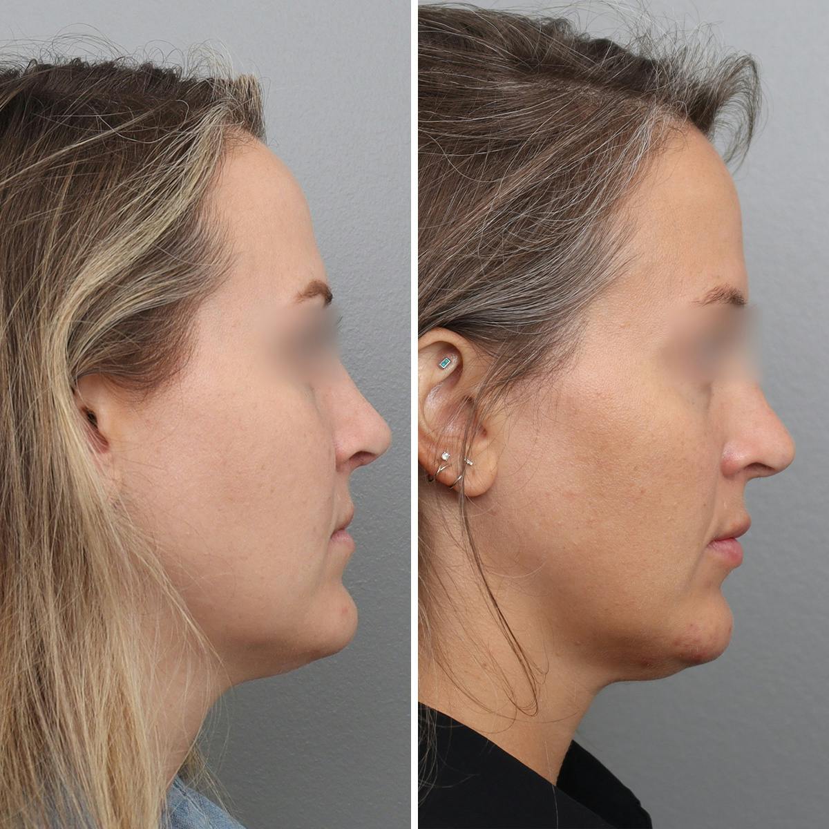Jawline/Chin Before & After Gallery - Patient 361607 - Image 3