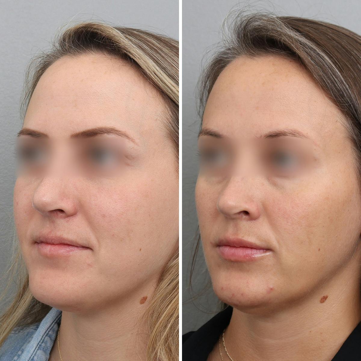 Jawline/Chin Before & After Gallery - Patient 361607 - Image 4