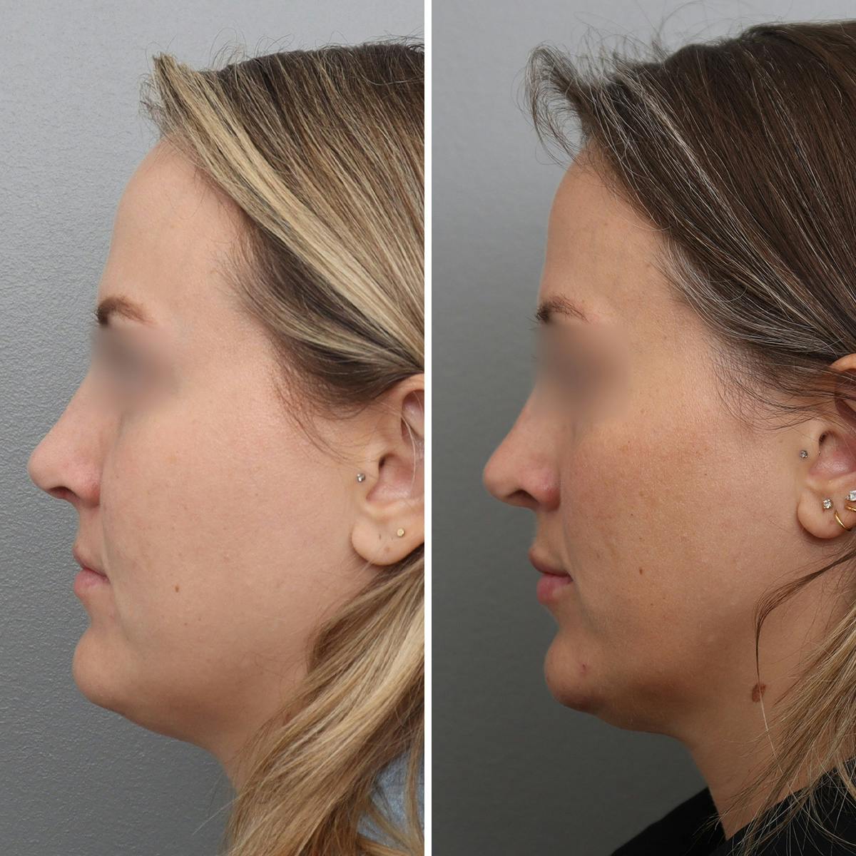 Jawline/Chin Before & After Gallery - Patient 361607 - Image 5
