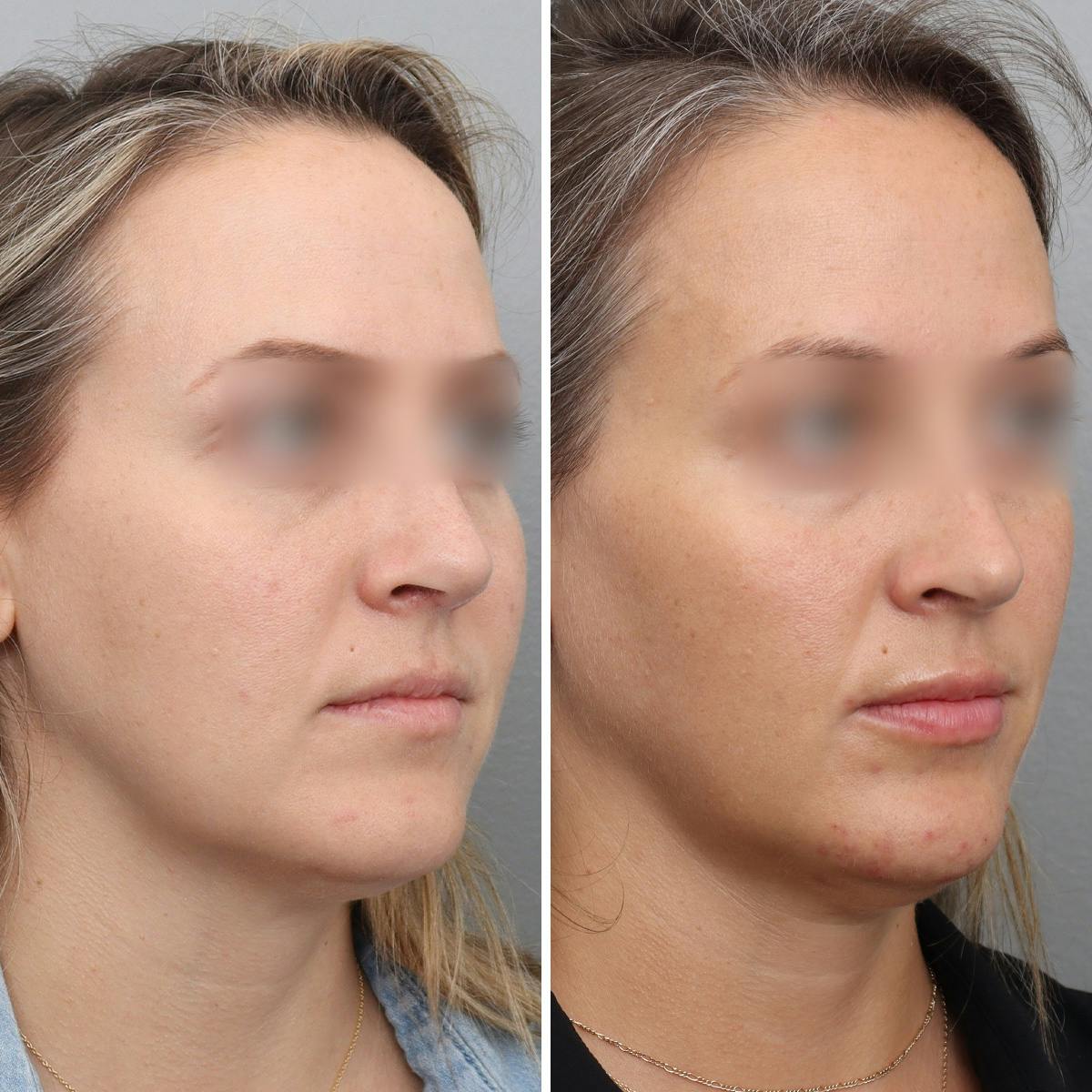 Jawline/Chin Before & After Gallery - Patient 361607 - Image 2