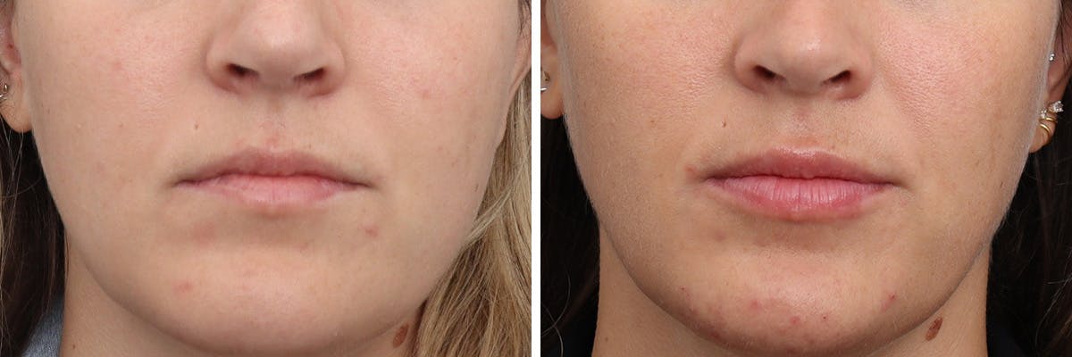 Lip Augmentation Before & After Gallery - Patient 212486 - Image 1