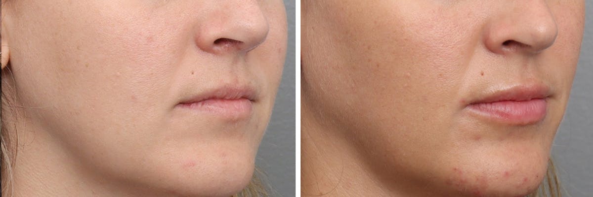 Lip Augmentation Before & After Gallery - Patient 212486 - Image 2
