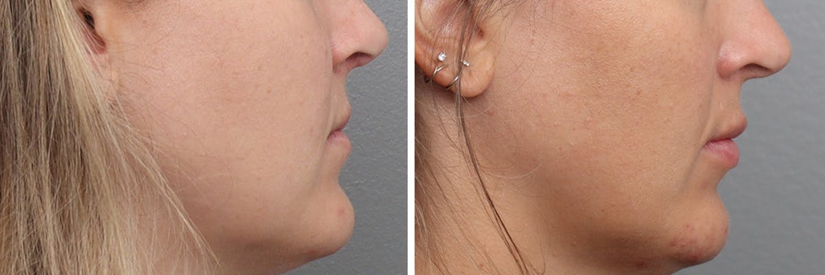 Lip Augmentation Before & After Gallery - Patient 212486 - Image 3