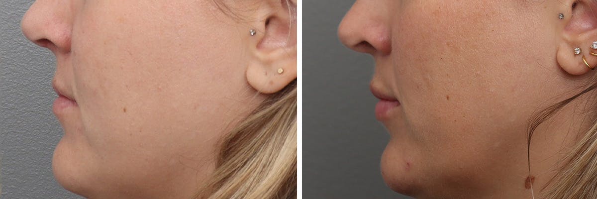 Lip Augmentation Before & After Gallery - Patient 212486 - Image 5
