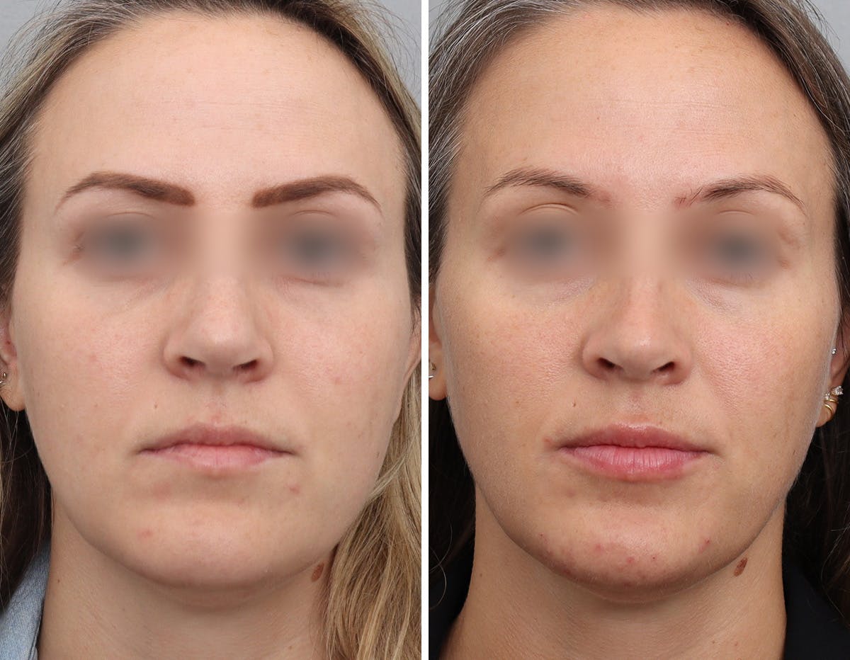 Non-Surgical Facelift Before & After Gallery - Patient 154623 - Image 1