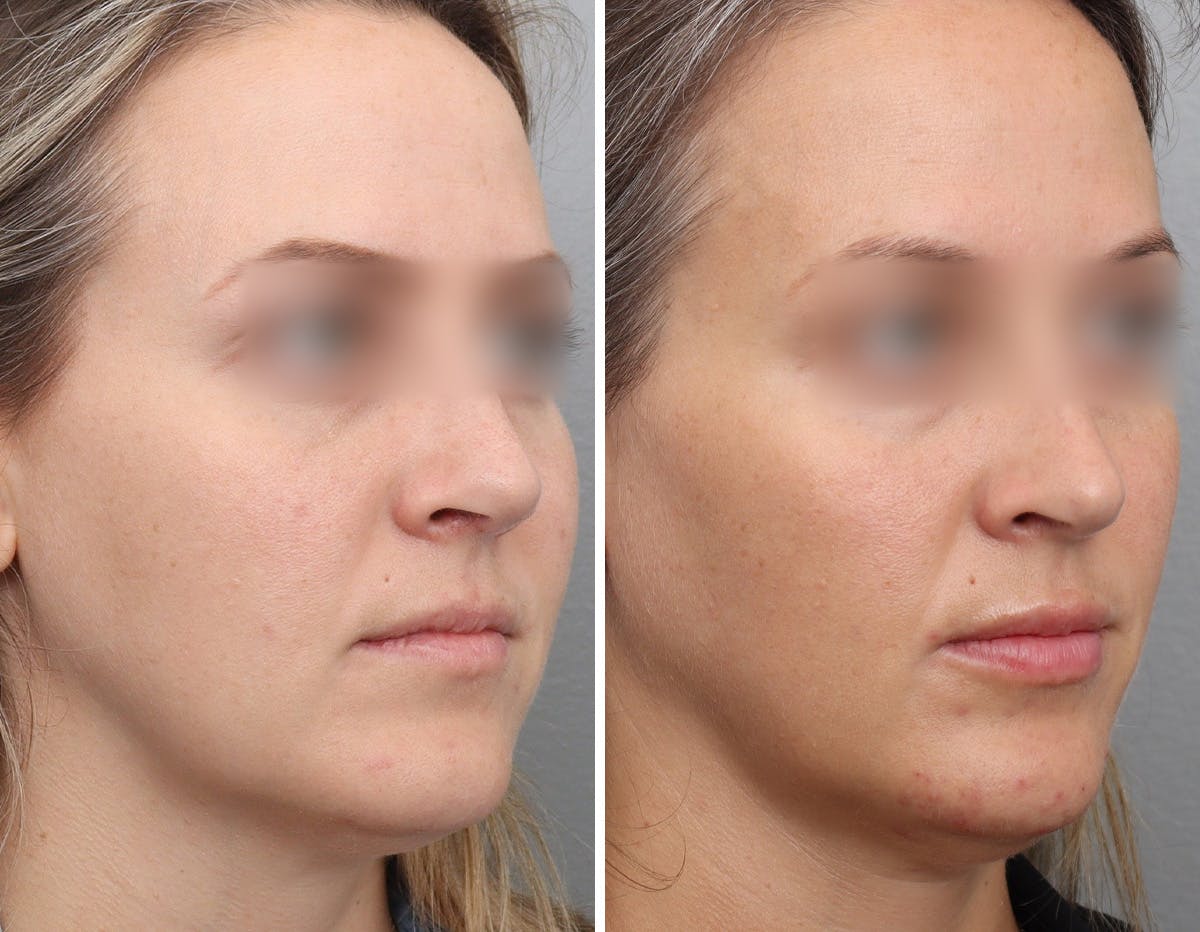 Non-Surgical Facelift Before & After Gallery - Patient 154623 - Image 2