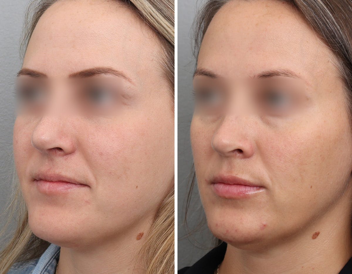 Non-Surgical Facelift Before & After Gallery - Patient 154623 - Image 4