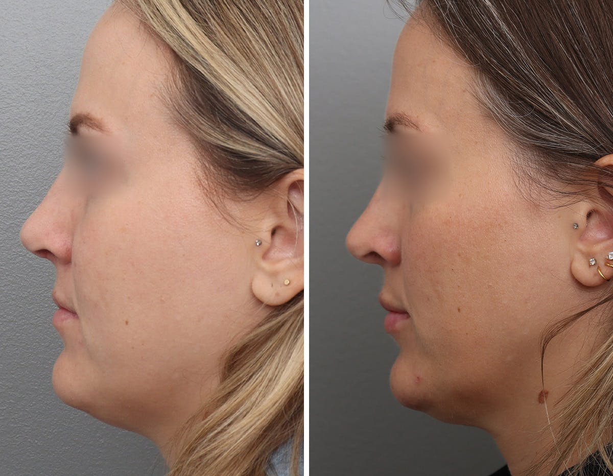 Non-Surgical Facelift Before & After Gallery - Patient 154623 - Image 5