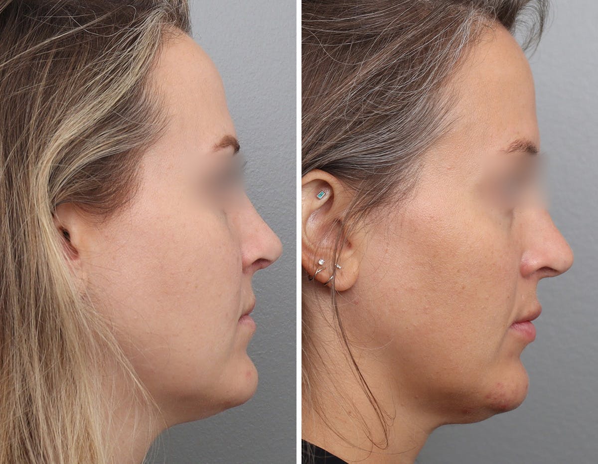 Non-Surgical Facelift Before & After Gallery - Patient 154623 - Image 3