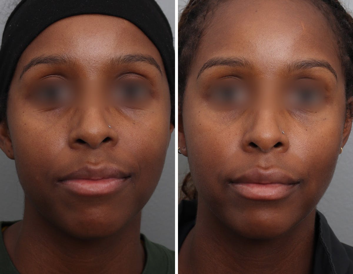 Non-Surgical Facelift Before & After Gallery - Patient 409910 - Image 1