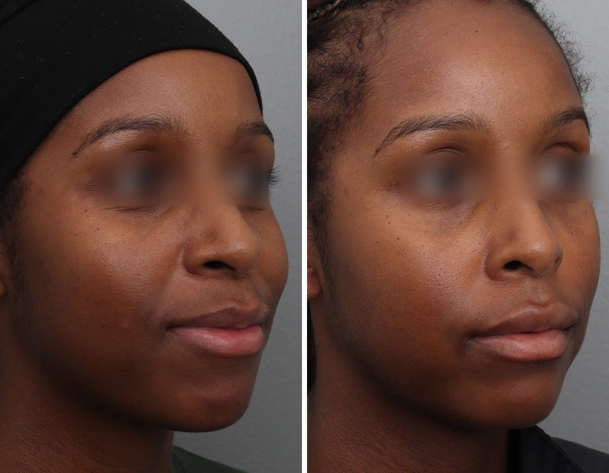 Non-Surgical Facelift Before & After Gallery - Patient 409910 - Image 2
