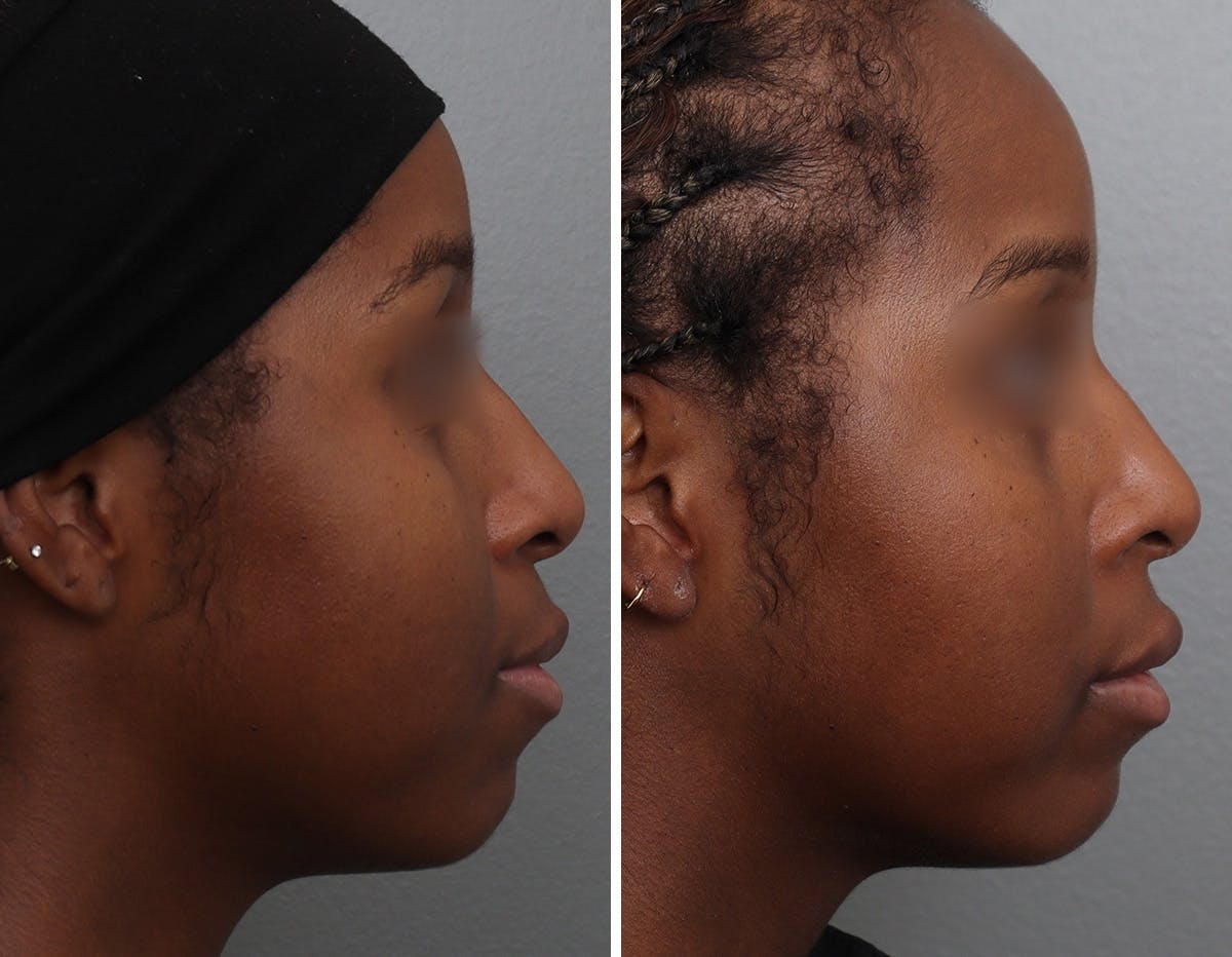 Non-Surgical Facelift Before & After Gallery - Patient 409910 - Image 3