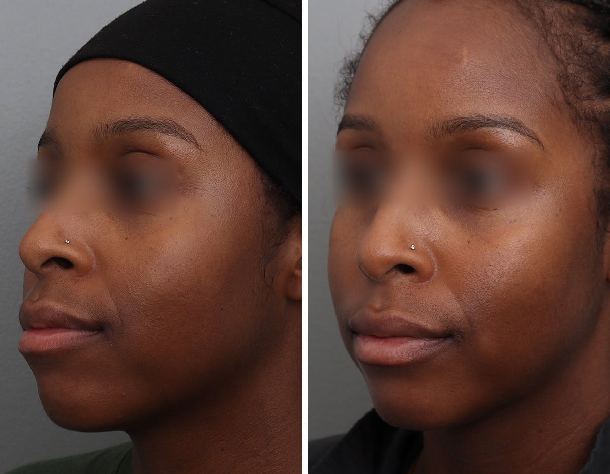 Non-Surgical Facelift Before & After Gallery - Patient 409910 - Image 4