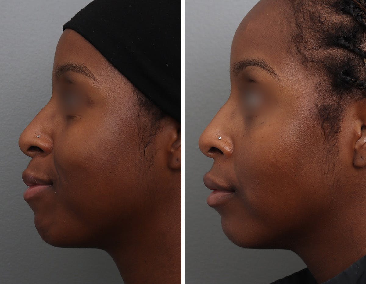 Non-Surgical Facelift Before & After Gallery - Patient 409910 - Image 5