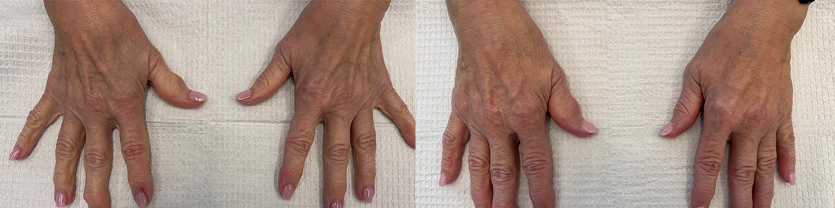 Hand Rejuvenation Before & After Gallery - Patient 155061 - Image 1
