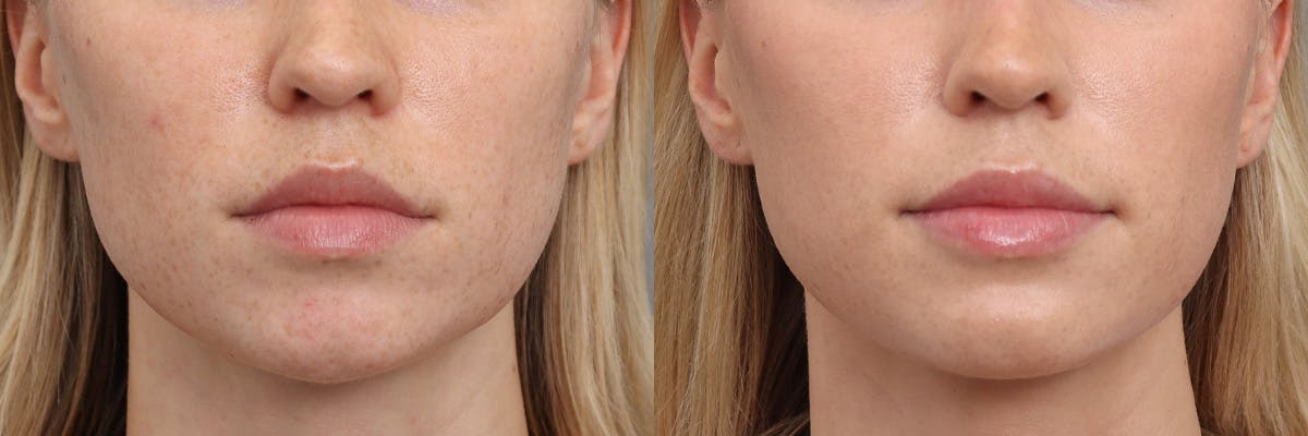 Lip Augmentation Before & After Gallery - Patient 301898 - Image 1