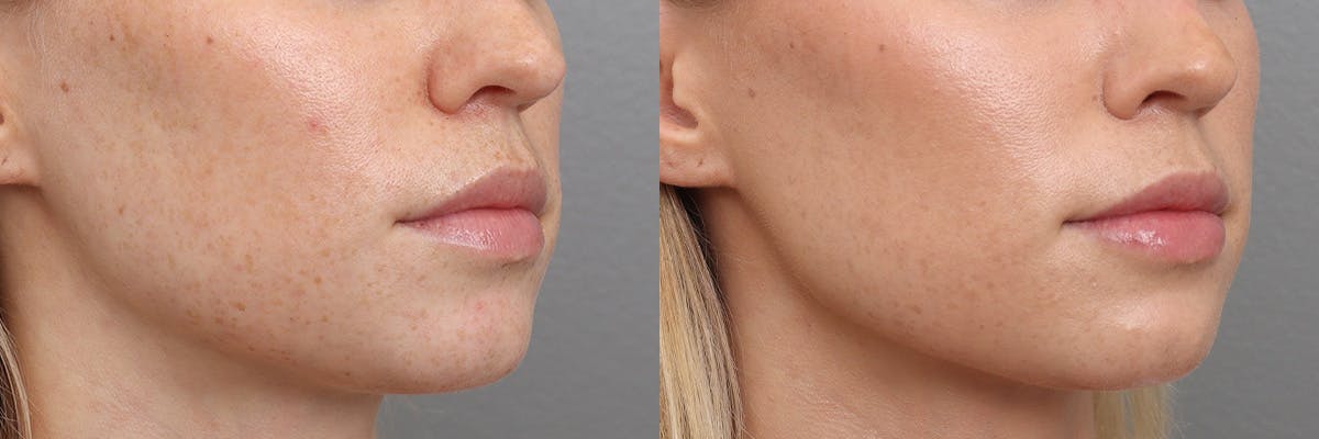 Lip Augmentation Before & After Gallery - Patient 301898 - Image 2
