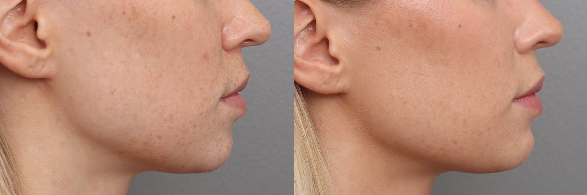 Lip Augmentation Before & After Gallery - Patient 301898 - Image 3