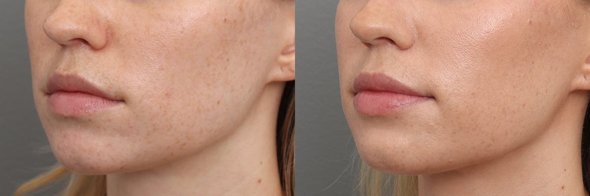 Lip Augmentation Before & After Gallery - Patient 301898 - Image 4