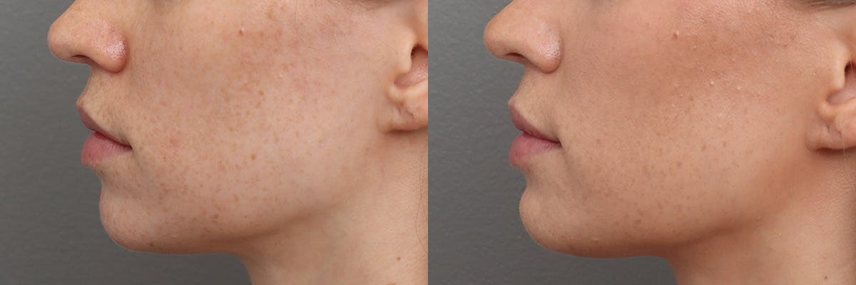 Lip Augmentation Before & After Gallery - Patient 301898 - Image 5