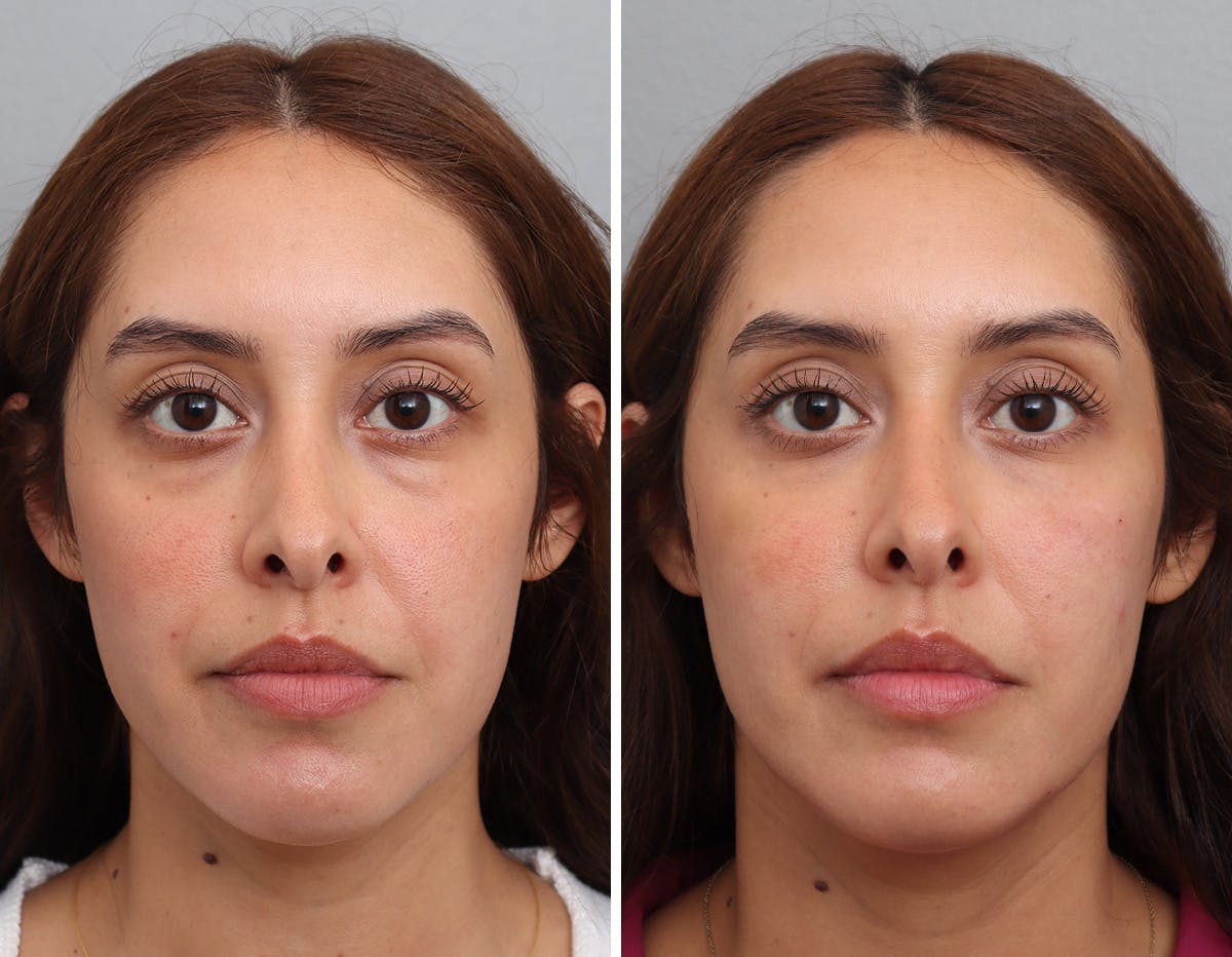 Non-Surgical Facelift Before & After Gallery - Patient 188724 - Image 1