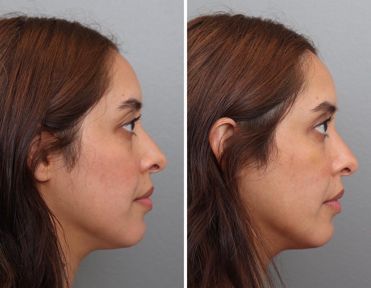 Non-Surgical Facelift Before & After Gallery - Patient 188724 - Image 3
