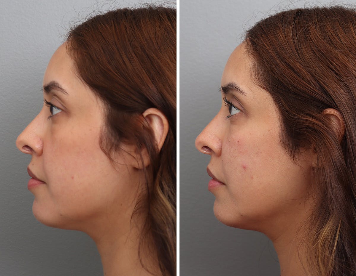 Non-Surgical Facelift Before & After Gallery - Patient 188724 - Image 4