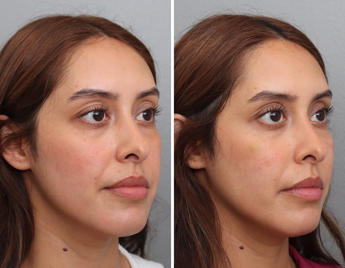 Non-Surgical Facelift Before & After Gallery - Patient 188724 - Image 2